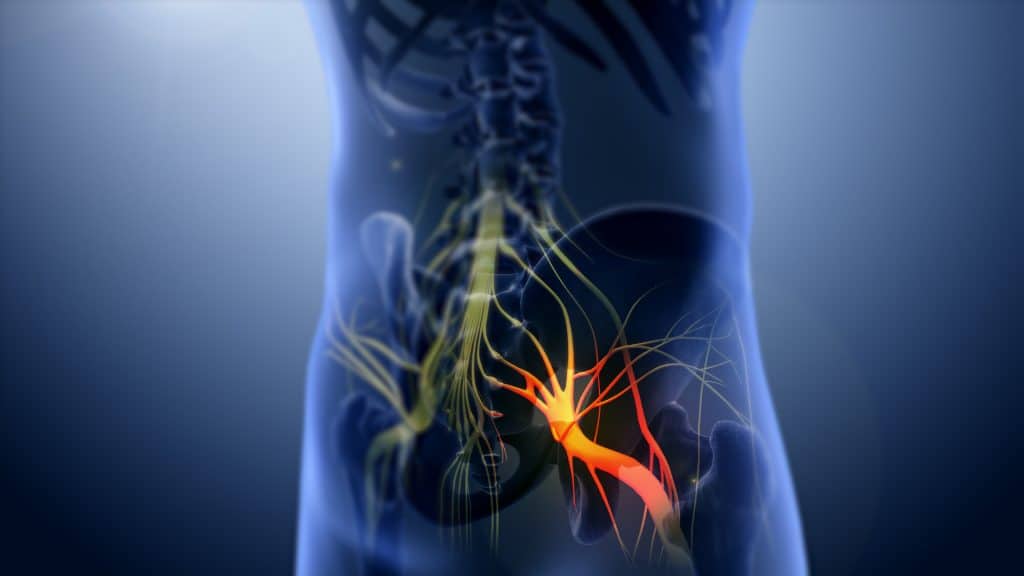 Is it Sciatica or Piriformis Syndrome? - Cold Spring Chiropractic