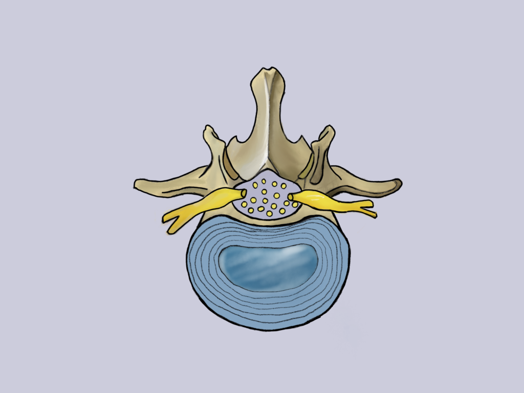 What is a slipped disc - Crestacre Chiropractic Clinic